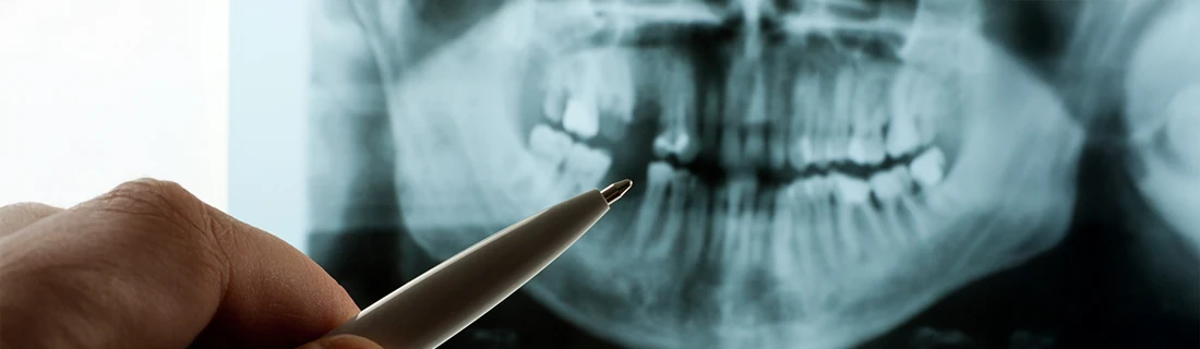 Dentist Chicago IL Doctor Pointing To Missing Tooth X-Ray Dentist Chicago IL Doctor Pointing To Missing Tooth X-Ray
