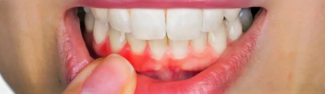 Dentist Chicago IL Periodontal Disease Dentist Chicago IL Periodontal Disease