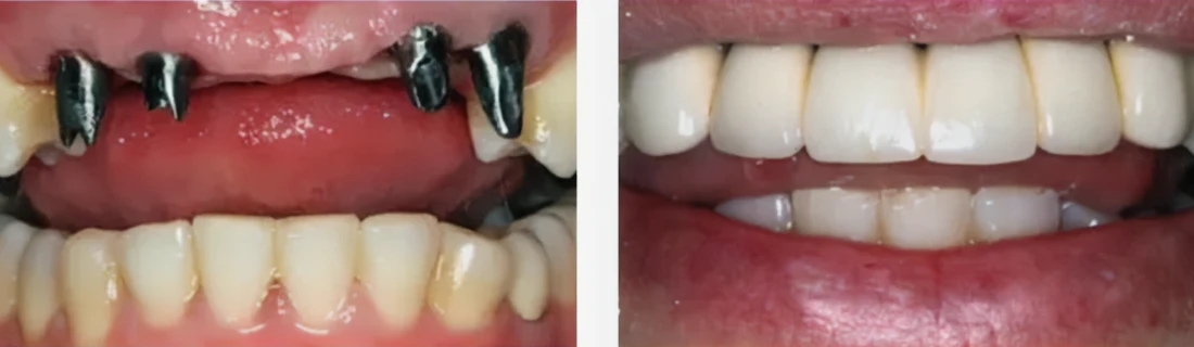 Dentist Chicago IL Restorative Dentistry Implant Before After Dentist Chicago IL Restorative Dentistry Implant Before After
