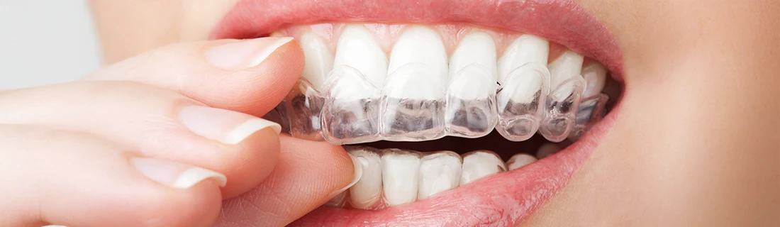 Dentist Chicago IL Woman Removing Her Clear Aligner Dentist Chicago IL Woman Removing Her Clear Aligner