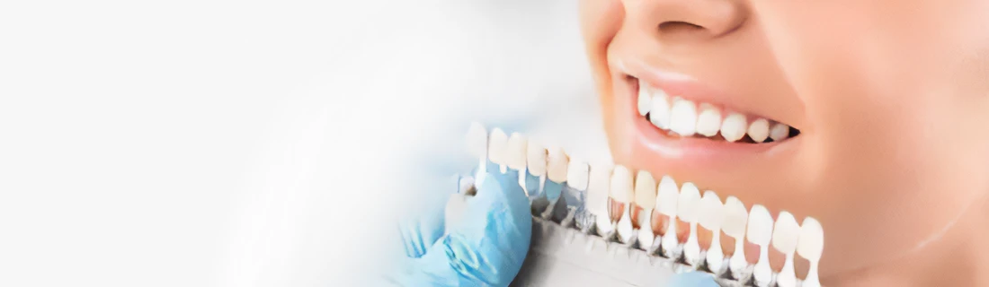 Dentist Chicago IL Woman Tooth Color Matching Dentist Chicago IL Woman Tooth Color Matching